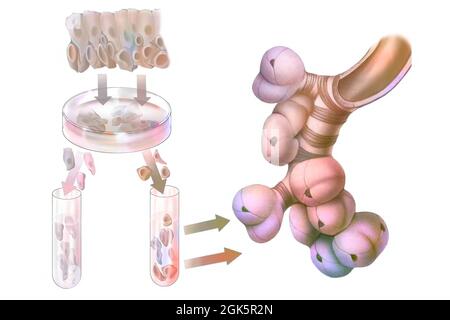 Culture de cellules souches bronchiques pour implantation dans les alvéoles pulmonaires. Banque D'Images