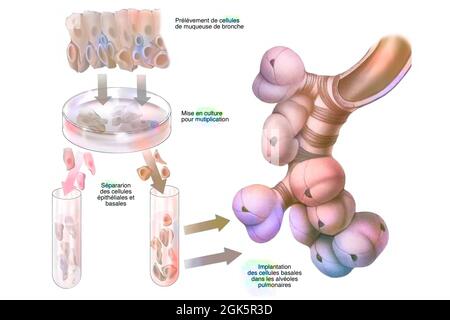 Culture de cellules souches bronchiques pour implantation dans les alvéoles pulmonaires. Banque D'Images