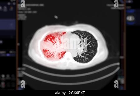 Foyer sélectif de l'acquisition CT de la vue mip axiale du thorax ou du poumon de l'infection pulmonaire Covid-19 avec opacité de verre rodé . Banque D'Images