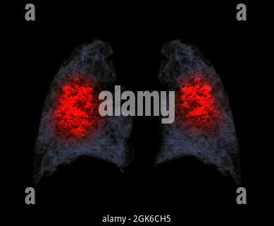 Rendu 3d CT du thorax montrant une infection pulmonaire due à Covid-19. Banque D'Images