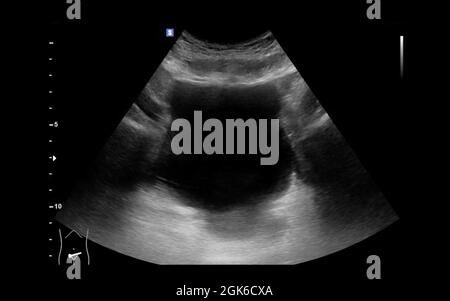 Échographie de la vessie urinaire ou KUB pour le dépistage de la maladie rénale et de la vessie. Banque D'Images