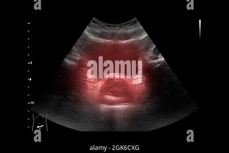 Échographie de la vessie urinaire ou KUB pour le dépistage de la maladie rénale et de la vessie. Banque D'Images
