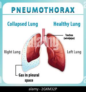 Schéma pneumothorax avec poumon collabé et poumon sain Illustration de Vecteur