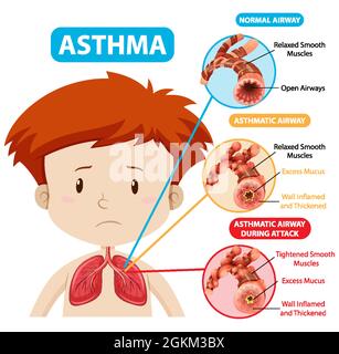 Schéma de l'asthme avec illustration des voies aériennes normales et des voies respiratoires asthmatiques Illustration de Vecteur