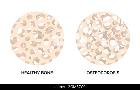 Tissu osseux endommagé par l'ostéoporose, par rapport aux os sains humains. Structure spongieuse du squelette normale et éclaircie, illustration vectorielle Illustration de Vecteur