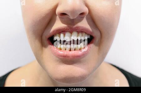 Femme à bouche ouverte avec dents tortravers Banque D'Images