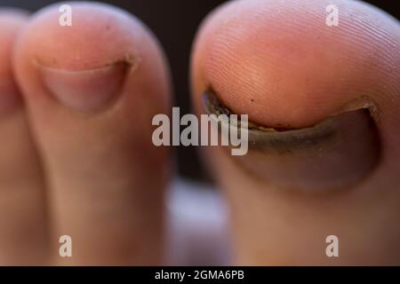 Santé des pieds d'ongle endommagés. Gros ongle d'orteil infecté par le champignon d'ongle. Banque D'Images