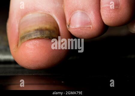 Orteil blessure clou levé orteil lit clou gros plan. Croissance des ongles épaissie due à des blessures et à une infection. Banque D'Images