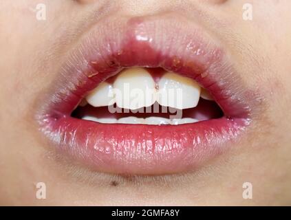 Stomatite angulaire ou chéilite angulaire ou perleche chez le petit garçon asiatique. Affection inflammatoire courante des angles de bouche. Séchez la peau et les lèvres du visage. Banque D'Images