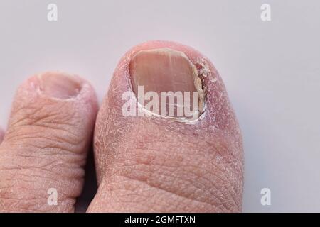 Infection de champignon d'ongle, onychomycose, sur le pouce de pied. Infection fongique sur le pied de l'ongle. Banque D'Images