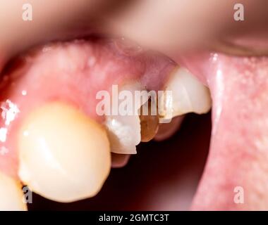 Une dent morte noire dans laquelle un morceau d'émail de dent est ébréché, une puce de dent. Le concept de la restauration dentaire dans la dentisterie moderne, macro. Orthod Banque D'Images