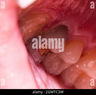 Morceau ébréché d'une dent de pulpe morte. Restauration d'une dent endommagée en dentisterie, défaut dans l'émail des dents, parois minces des dents. Macro, traitement Banque D'Images