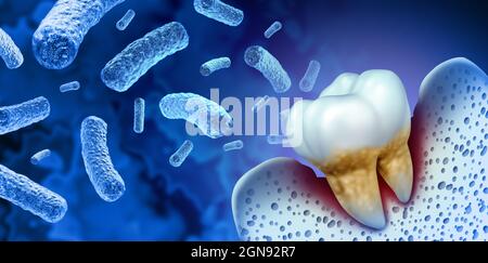 Infection bactérienne des dents et maladie de la carie dentaire comme un molaire malsain avec parodontite due à un problème d'hygiène buccale pauvre de santé comme un infectieux. Banque D'Images