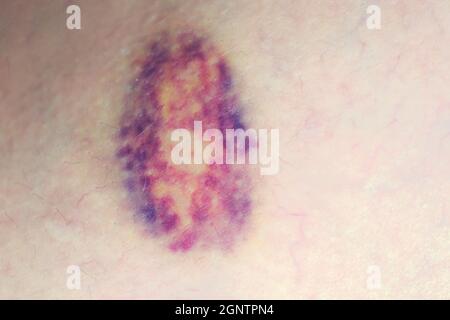 Gros ecchymose sur le corps humain, gros plan Banque D'Images