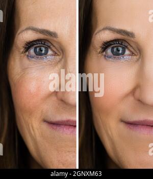 Anti rajeunissement rides lever avant et après Banque D'Images
