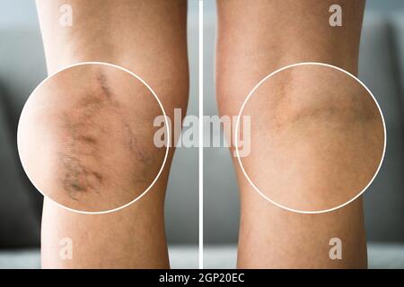 Avant après l'inflammation de la cellulite jambes traitement gros plan Banque D'Images