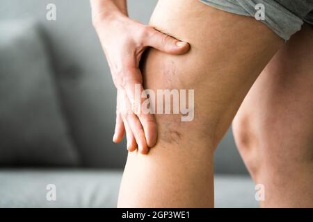 Avant après l'inflammation de la cellulite jambes traitement gros plan Banque D'Images