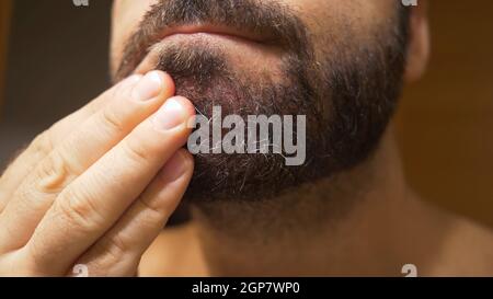 Détail du menton de l'homme avec une dermatite séborrhéique dans la zone de la barbe. La peau sèche se déchèche et provoque des démangeaisons et des pellicules. Banque D'Images