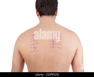 L'allergie cutanée Patch Test à l'arrière de l'homme Patient sur fond blanc Banque D'Images