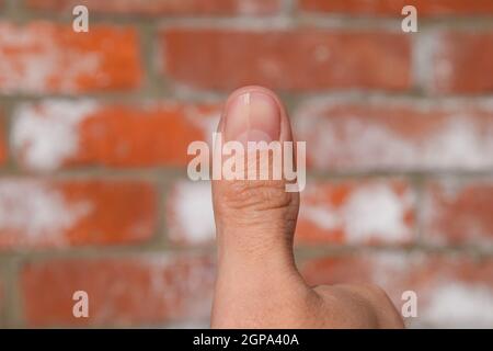 Ongle fourchue sur le pouce. Dilatation de l'ongle, la pathologie traumatique. Le clou est divisé en deux. Banque D'Images