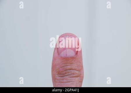 Ongle fourchue sur le pouce. Dilatation de l'ongle, la pathologie traumatique. Le clou est divisé en deux. Banque D'Images