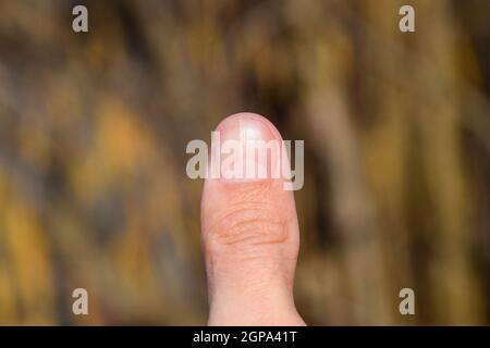 Ongle fourchue sur le pouce. Dilatation de l'ongle, la pathologie traumatique. Le clou est divisé en deux. Banque D'Images