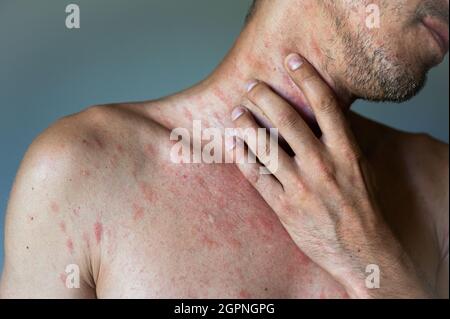 Le corps de l'homme adulte a repéré, le bouton rouge et l'éruption de bulles provenant du virus de la varicelle ou du zona varicelle. Homme présentant des symptômes d'urticaire itchy. Banque D'Images