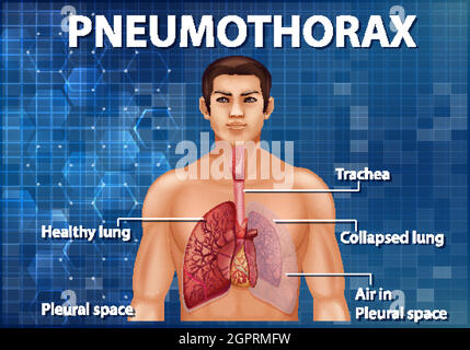 Illustration informative du pneumothorax Illustration de Vecteur