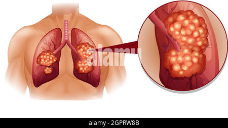 Diagramme du cancer du poumon en détails Illustration de Vecteur