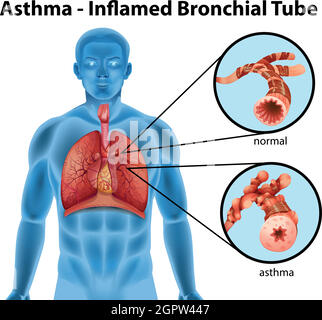 Tube bronchique à inflammation d'asthme Illustration de Vecteur