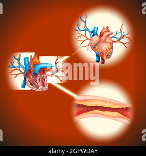 Cholesteral dans le coeur humain Illustration de Vecteur