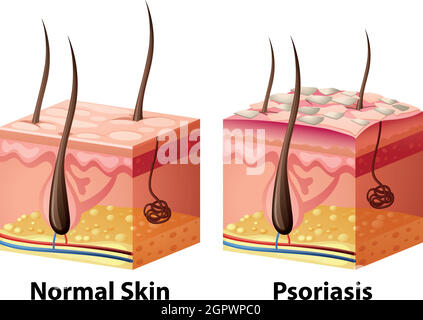 Schéma de la peau humaine avec normale et psoriasis Illustration de Vecteur