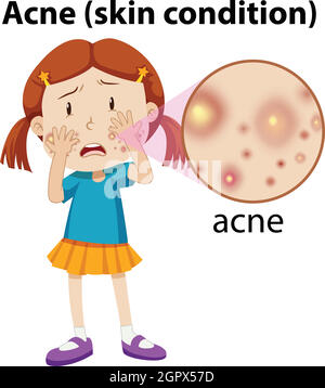 Une jeune fille ayant l'acné Illustration de Vecteur