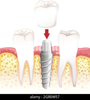Procédure de couronne dentaire Illustration de Vecteur