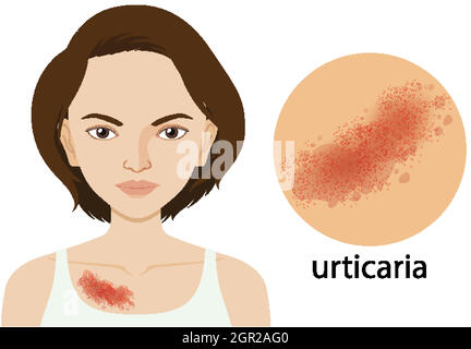 Schéma montrant l'urticaire sur une femme humaine Illustration de Vecteur