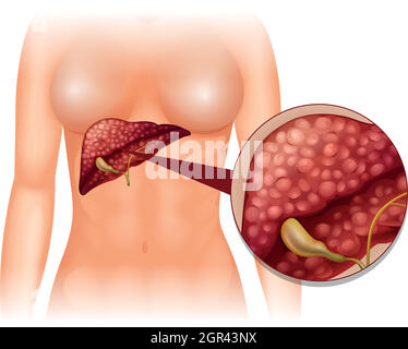 Cancer de la sclérose dans le corps humain Illustration de Vecteur