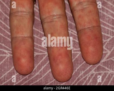 dermatologie infection sur l'homme adulte, la fièvre des cicatrices Banque D'Images