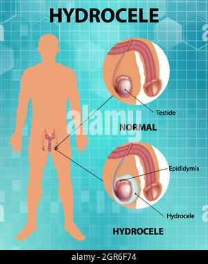 Affiche médicale montrant différents entre le testicule normal mâle et l'hydrocèle Illustration de Vecteur