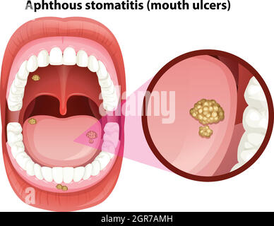 Bouche humaine Anatomie des ulcères Illustration de Vecteur