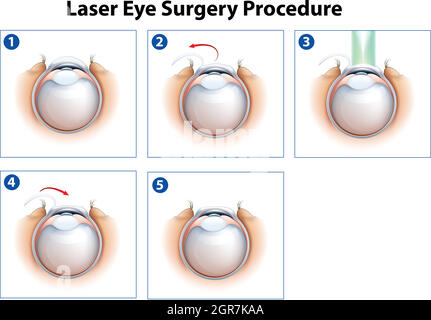 Procédure de chirurgie oculaire au laser Illustration de Vecteur