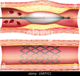 Angioplastie du stent Illustration de Vecteur