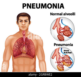 Comparaison d'alvéoles saines et de pneumonie Illustration de Vecteur