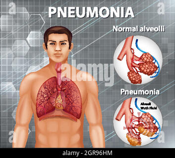 Comparaison d'alvéoles saines et de pneumonie Illustration de Vecteur