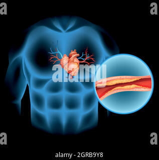 Coeur Cholesteral dans le corps humain Illustration de Vecteur