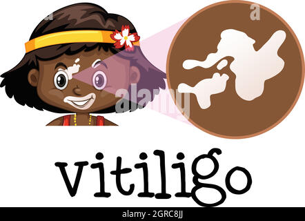 Éducation médicale humaine de Vitiligo Illustration de Vecteur