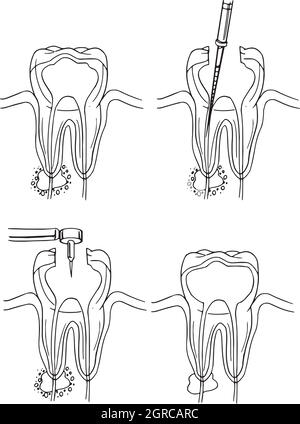 Procédure de canal racine Illustration de Vecteur