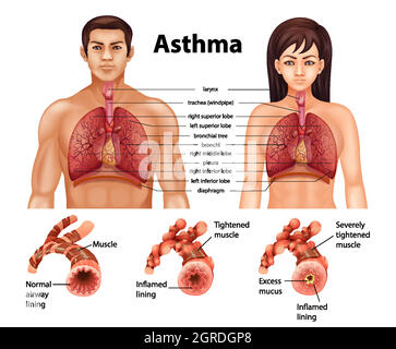 Comparaison des poumons sains et des poumons asthmatiques Illustration de Vecteur