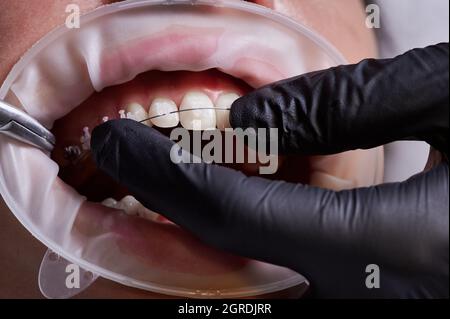 Gros plan des mains du dentiste avec des gants noirs faisant la procédure dentaire, processus de fixation des bretelles en céramique blanche et fil d'acier à l'aide d'une pince. Rétracteur à joue en latex sur la bouche. Concept de la dentisterie Banque D'Images