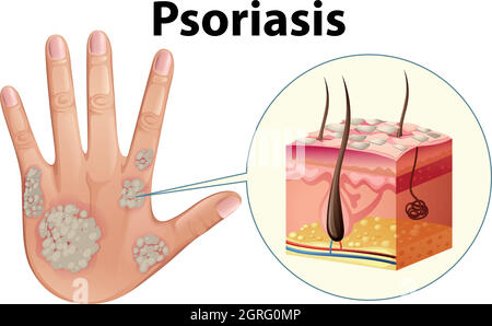 Schéma montrant le psoriasis de la main humaine Illustration de Vecteur