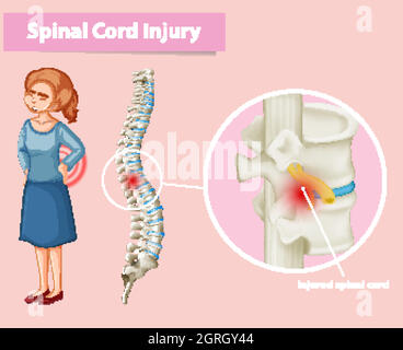 Schéma montrant une lésion de la moelle épinière chez l'homme Illustration de Vecteur
